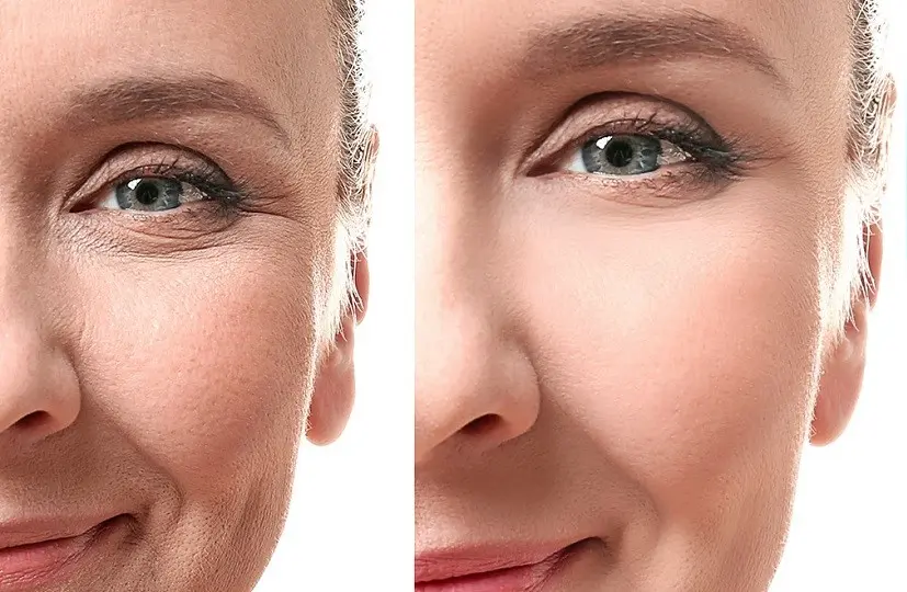 هزینه جوانسازی پوست