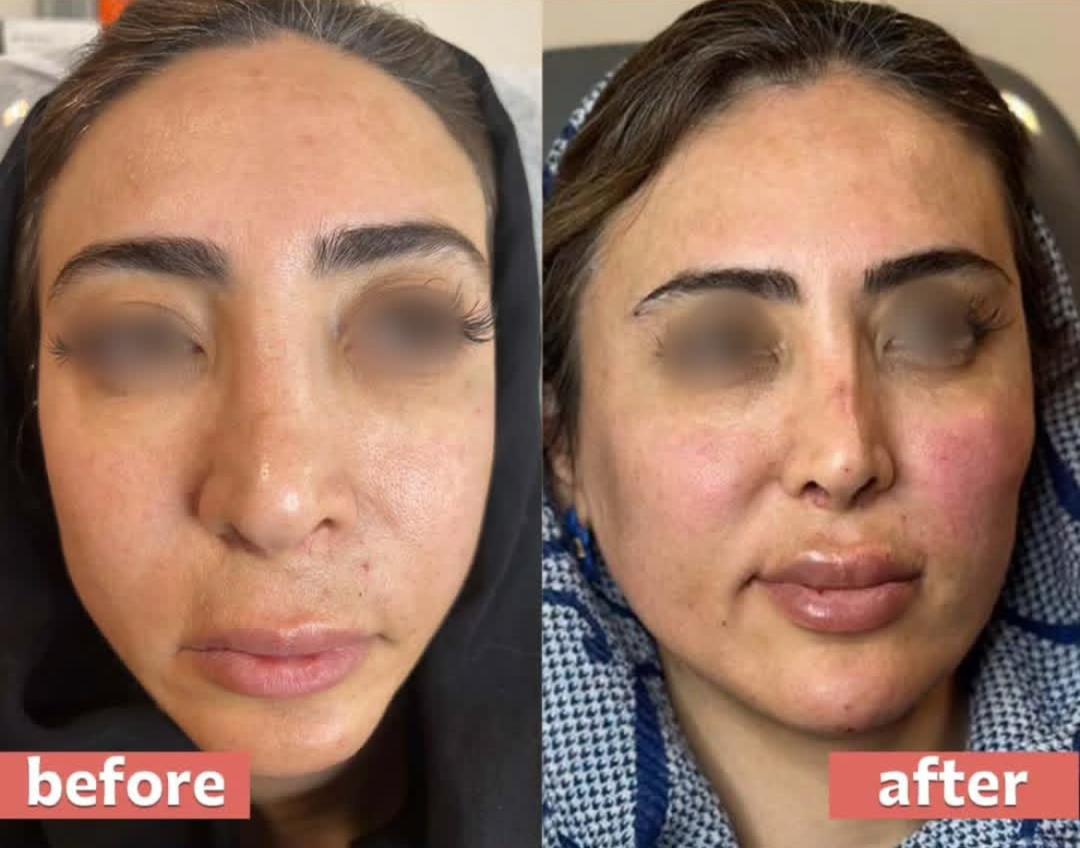 نمونه کار زاویه سازی صورت