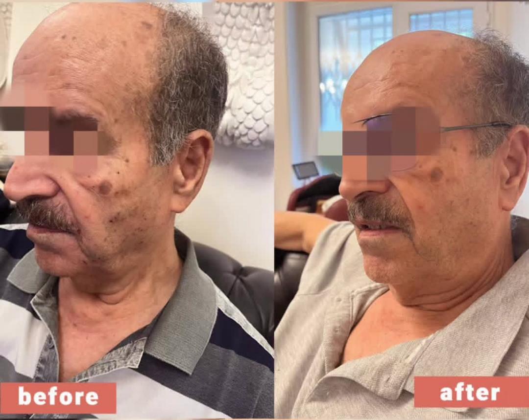 نمونه کار جوانسازی پوست با سلول بنیادی