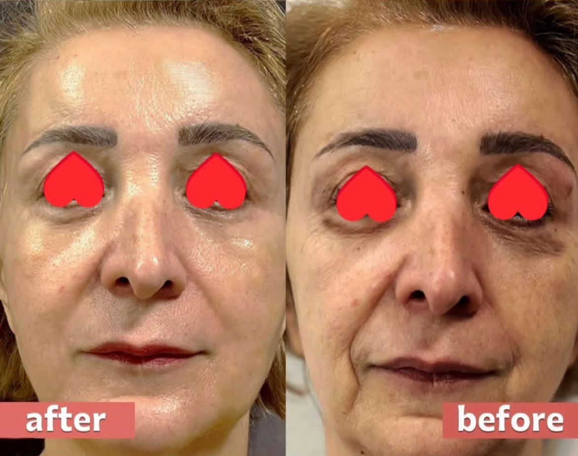 نمونه کار جوانسازی با سلول بنیادی