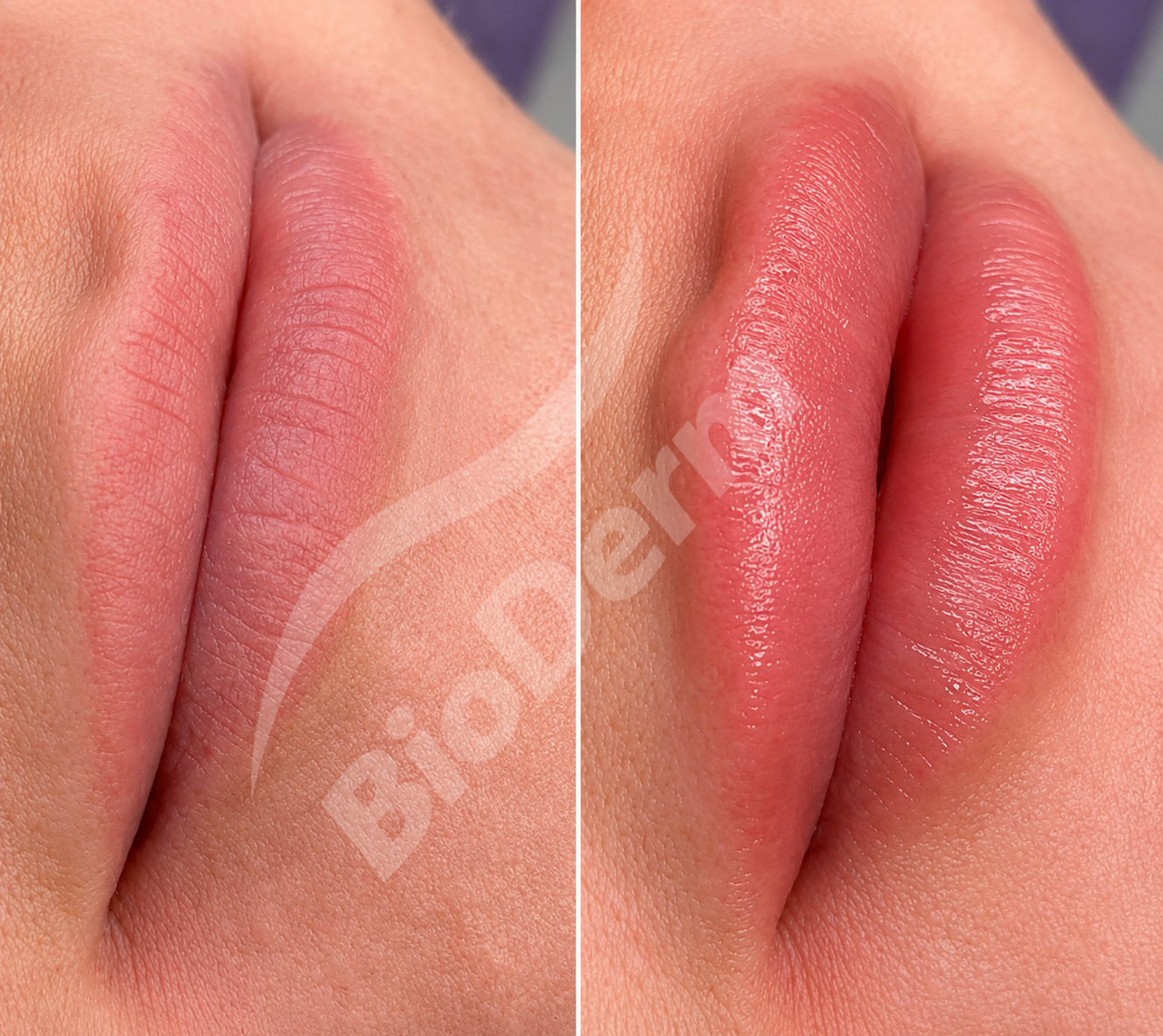 Bioderm rejunevation 1