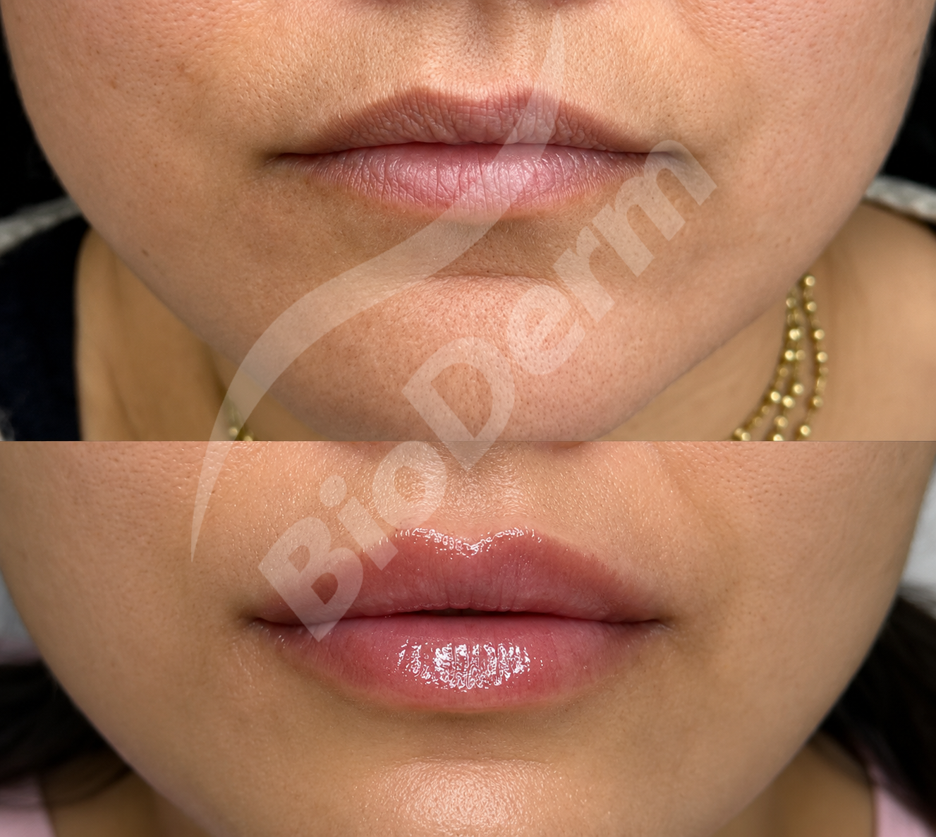 Bioderm rejunevation 8