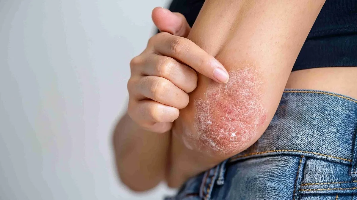 Plaque psoriasis