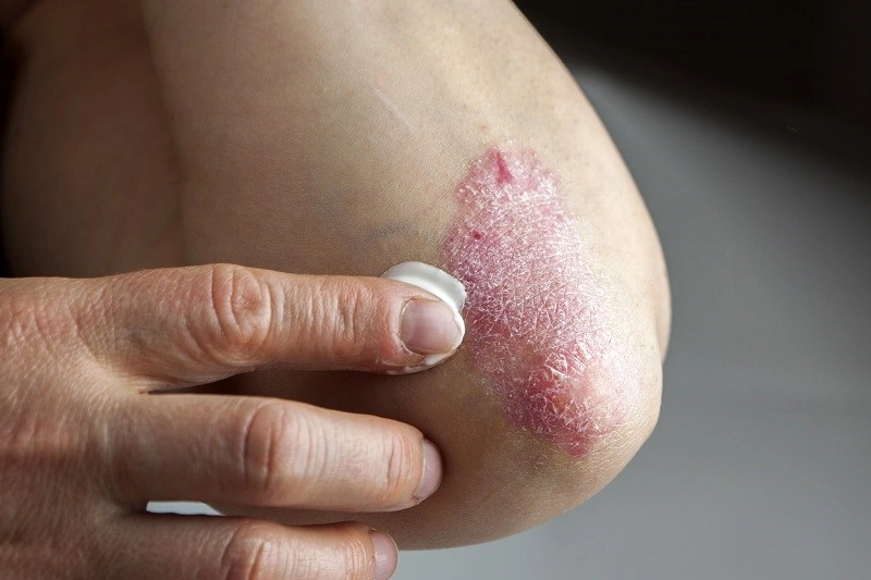 Treatment of plaque psoriasis