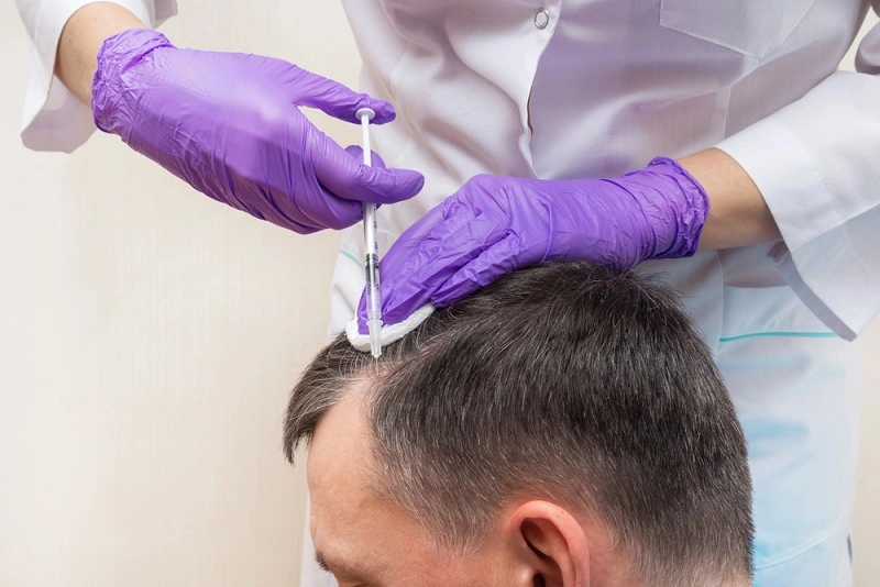 Benefits of undergoing hair mesotherapy at the right age