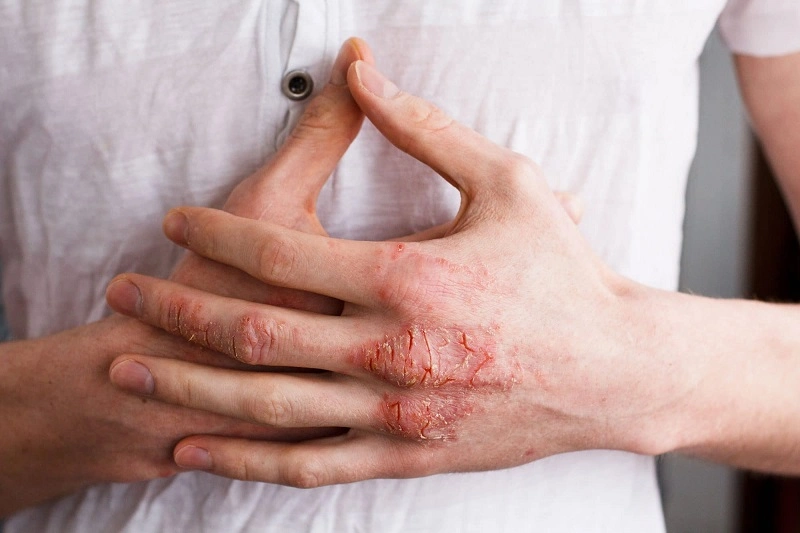 Can dry skin be prevented