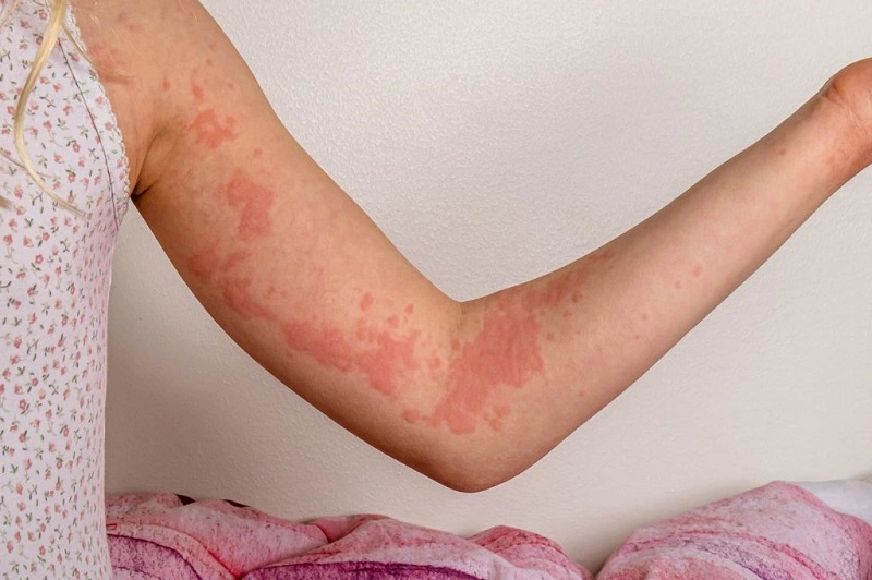 Home remedies for hives
