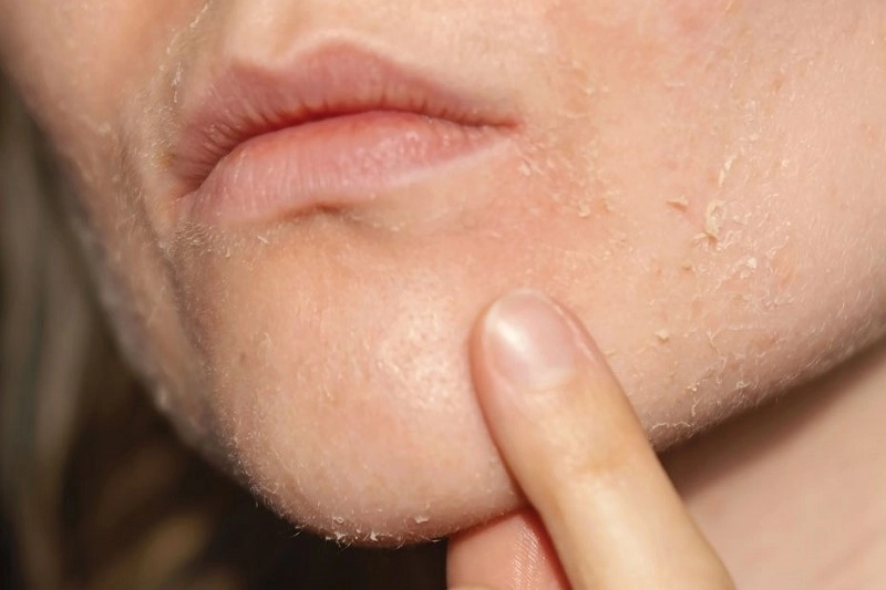 Symptoms of dry skin