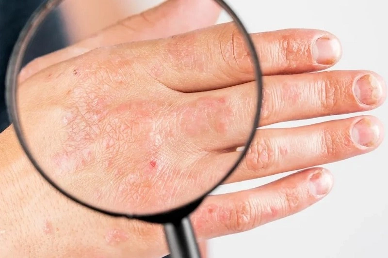 Symptoms of hives
