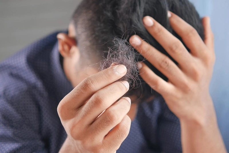 Types of stress induced hair loss