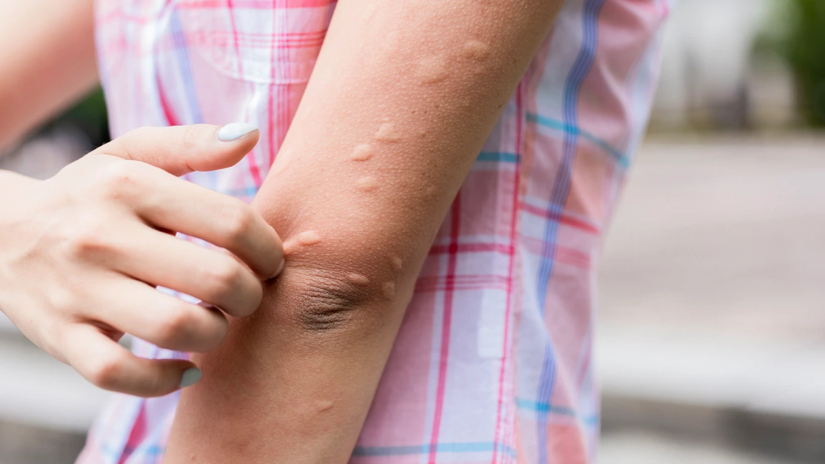 hives
