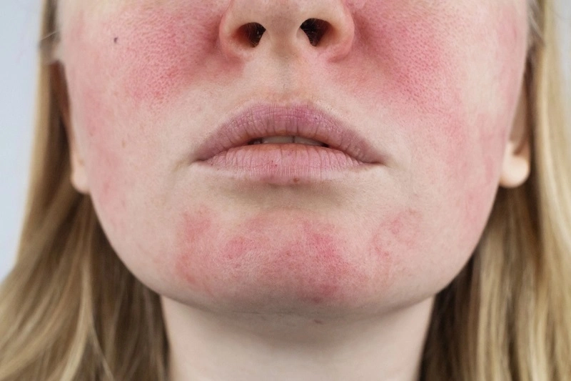 Skin sensitivity to alcohol