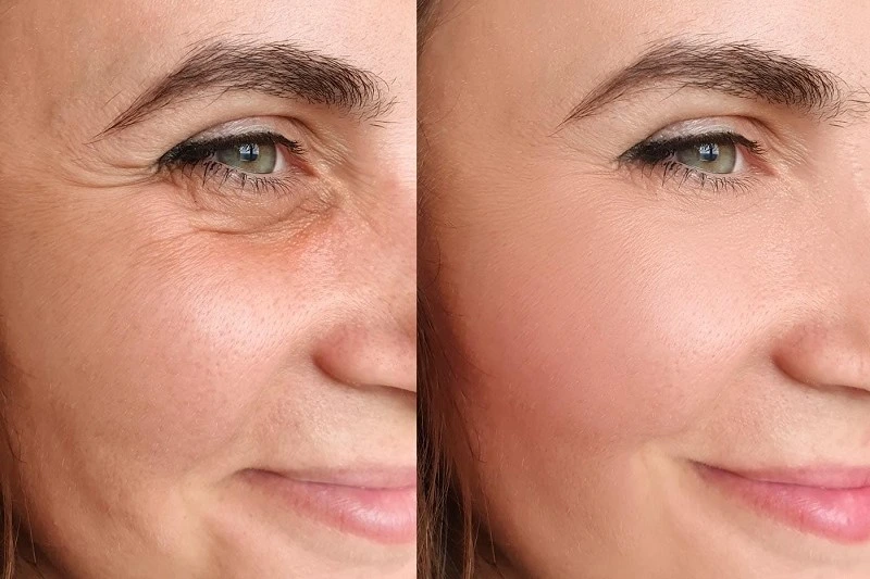 how educe crows feet fine lines female face 01